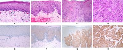 MicroRNAs and Long Non-Coding RNAs as Regulators of NANOG Expression in the Development of Oral Squamous Cell Carcinoma